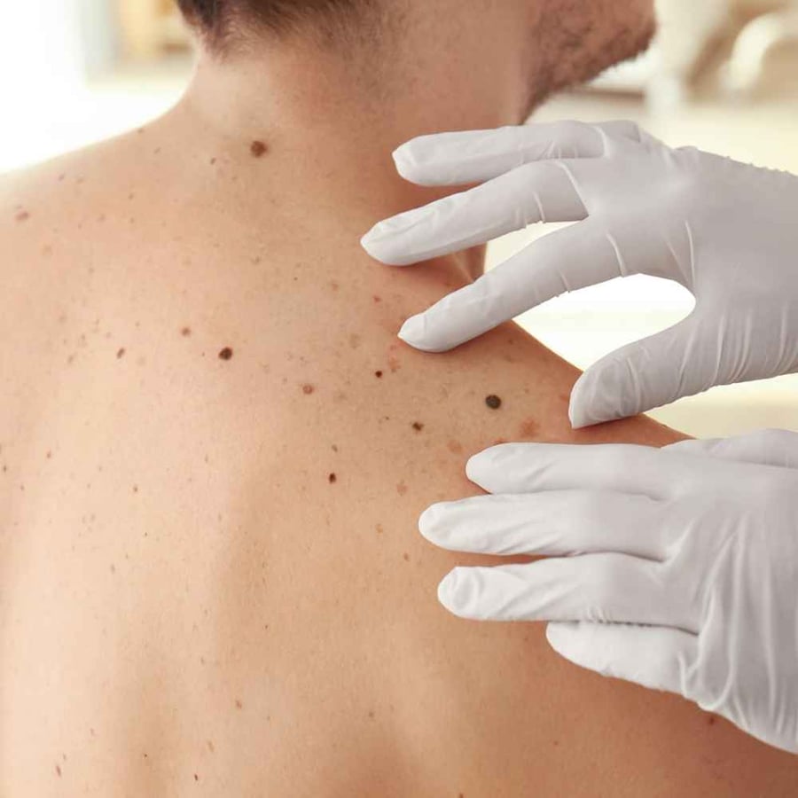 Melanoma Monday