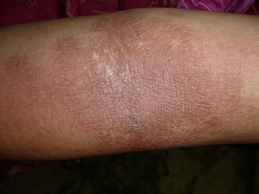 eczema on the elbows