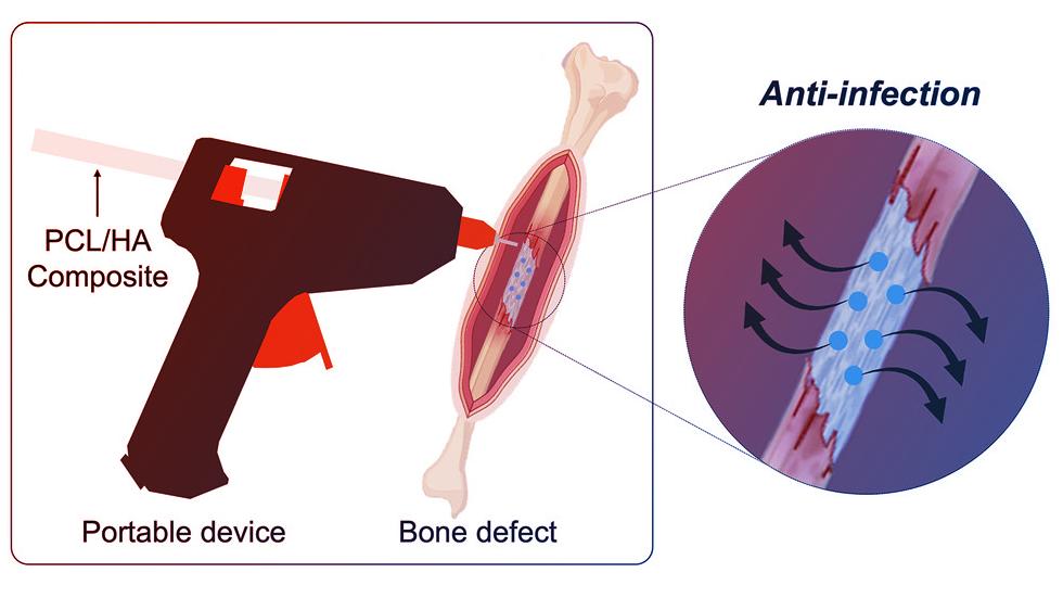 Az új csodafegyver: csontot nyomtat a ragasztópisztoly