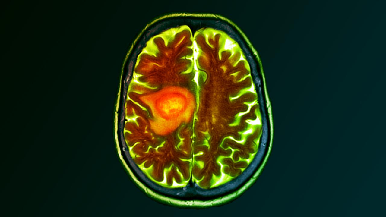 Egy egyszerű diéta segíthet az agydaganat ellen