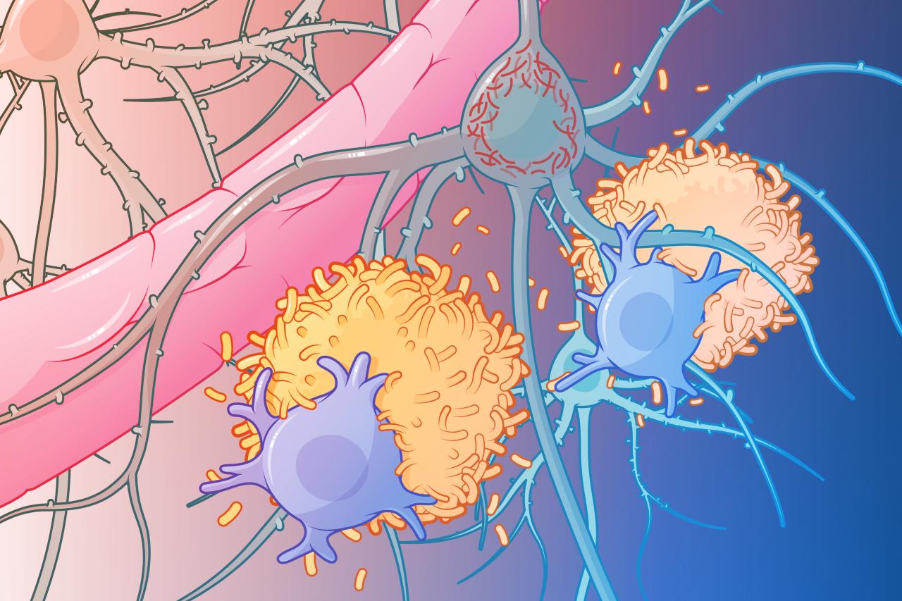 Új gyógyszerek jelennek meg, az Alzheimer okát kezelnék