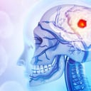 Amikor az agydaganat a koponyát is megtámadja, retteg az egész test