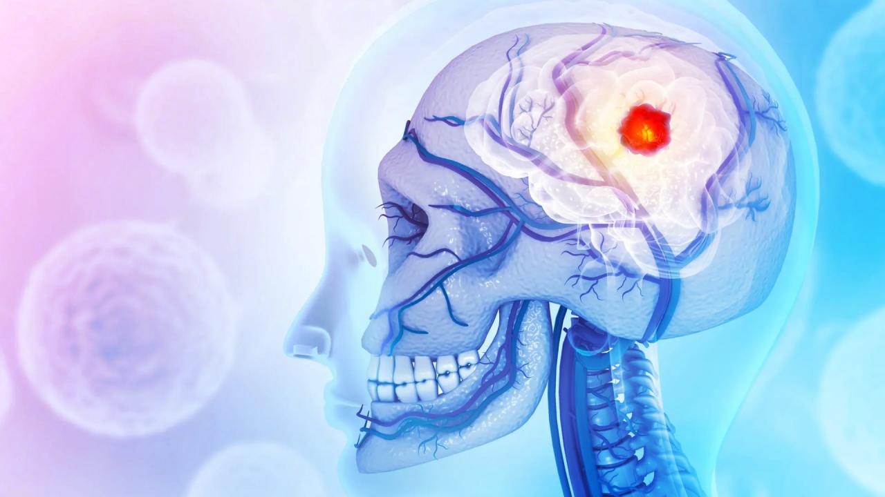 Amikor az agydaganat a koponyát is megtámadja, retteg az egész test