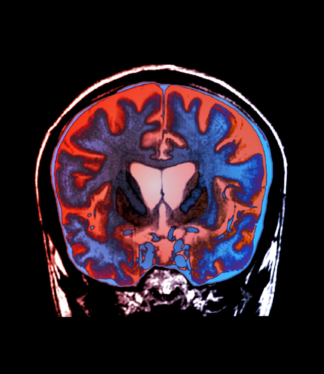 Van remény, a Huntington-kór lassítható lehet