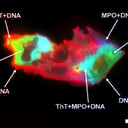 A hosszú COVID titka: rejtélyes vérrögök kavarják fel a tudományt