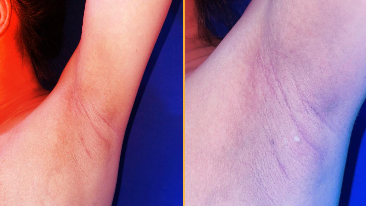 Anyatejet szivárgó hónalj: ritka mellrendellenesség