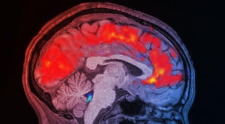 Az agy leáll: miért kapcsolsz le, ha kialvatlan vagy?