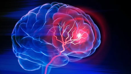 Az agyad sérül, mielőtt a vérnyomásod megugrana