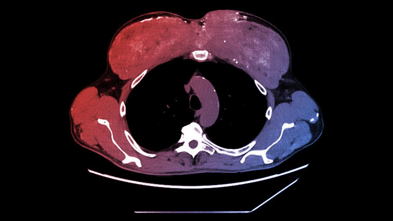 Az izomnövelő olaj évekkel később halálos árat követelt