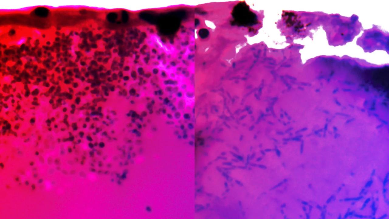 A halálos kórházi gombának végre megtalálták a gyenge pontját