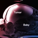 A hihetetlen eset: a baba a hasüregben fejlődött ki