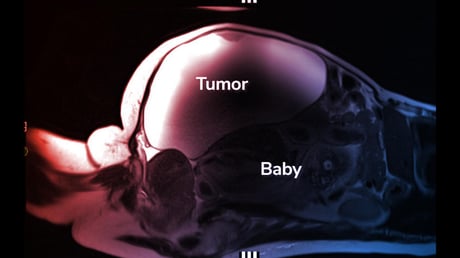 A hihetetlen eset: a baba a hasüregben fejlődött ki