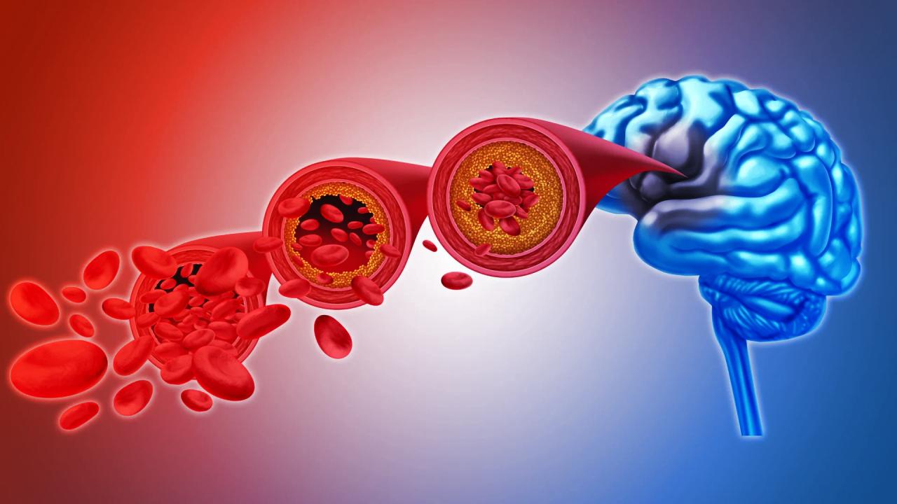 Az agyi véráramlás helyreállítása áttörést hozhat a demencia elleni harcban