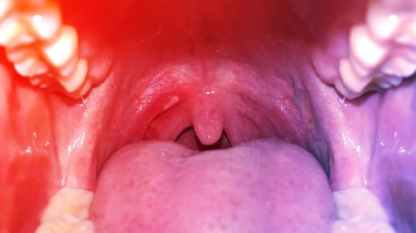 Az alkohol sötét oldala: egy pohár is szájrákot okozhat