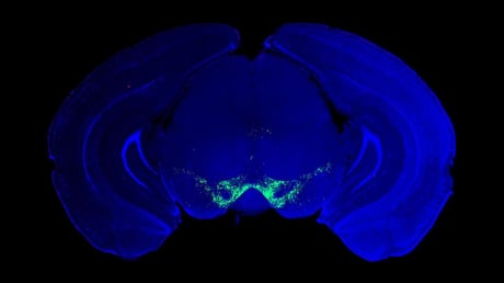 Az áttörés, amely forradalmasítja a Parkinson-kór kezelését