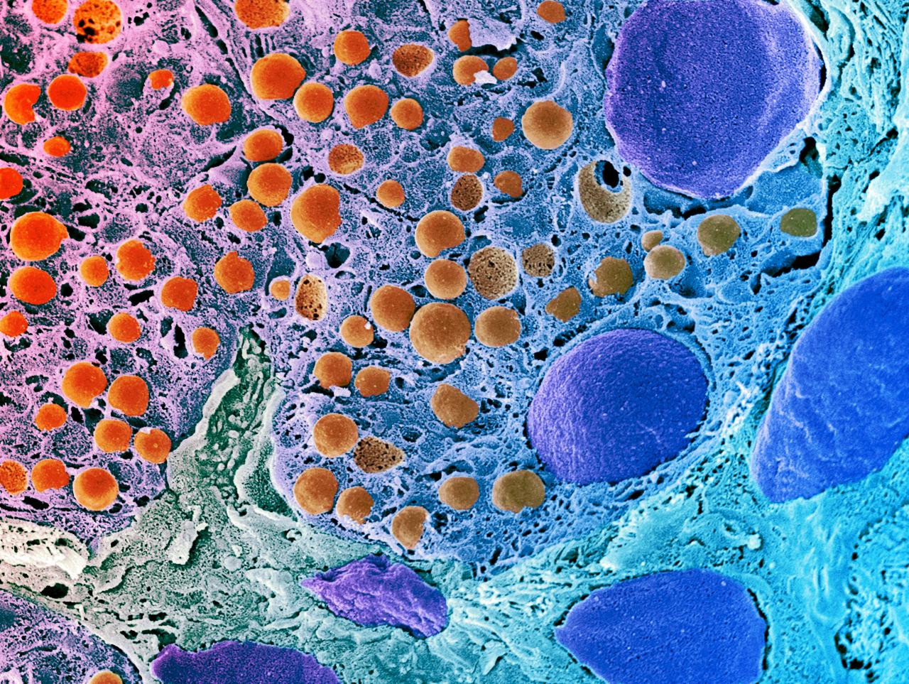 Az áttörés: újraindulhat az inzulintermelés 1-es típusú cukorbetegeknél