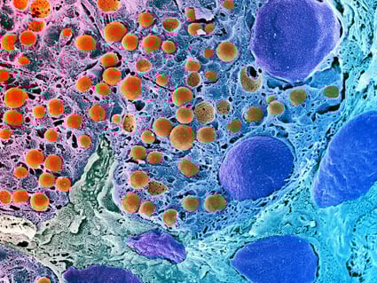 Az áttörés: újraindulhat az inzulintermelés 1-es típusú cukorbetegeknél