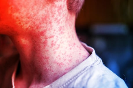 Az Egyesült Államokban járvány fenyeget: rohamosan terjed a kanyaró