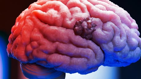 Az elfeledett terhességi szer újra harcba száll az agydaganatokkal