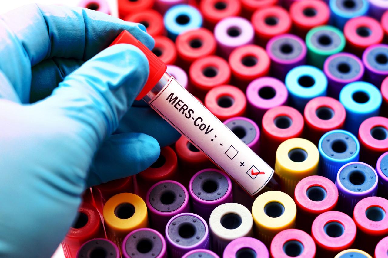 Az első MERS-eset 12 év után Franciaországban: a tevehús a bűnös?