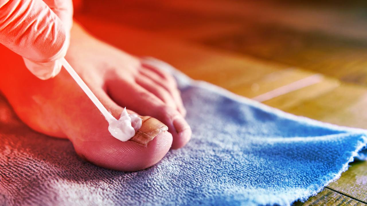 Az elviselhetetlen záptojásszag lehet a körömgomba végső ellenszere