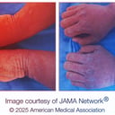 Az ember, akinek mosás után pikkelyesedik a keze