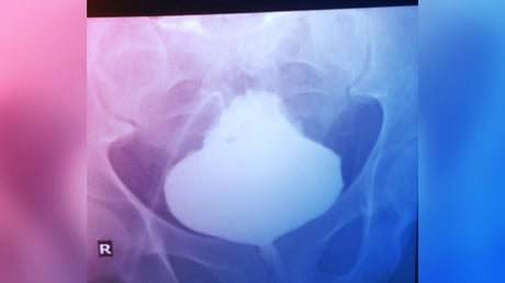 Az orvosok megdöbbentek: karácsonyfa lett egy férfi húgyhólyagja