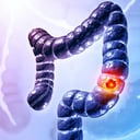 Az orvosok vészjelzése: a vastagbélrák egyre fiatalabbakat érint