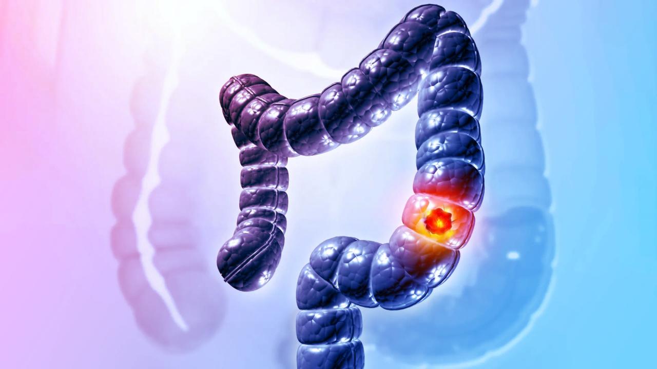 Az orvosok vészjelzése: a vastagbélrák egyre fiatalabbakat érint