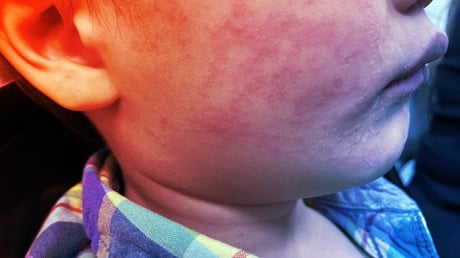 A kanyaró az oltatlanok között tombol Dél-Karolinában