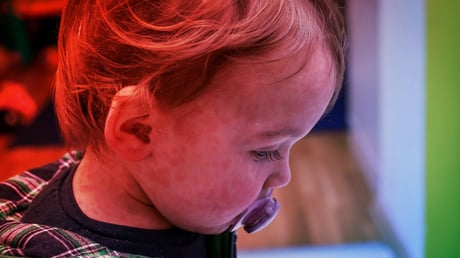 A kanyaró visszatért: az Egyesült Királyság már nem kanyarómentes