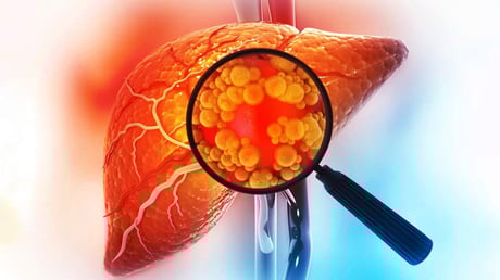 A zsírdús, egészségtelen étrend brutálisan megdobja a májrák esélyét