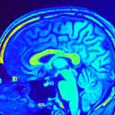 Az agyi MRI új korszakot nyithat a depresszió gyógyításában