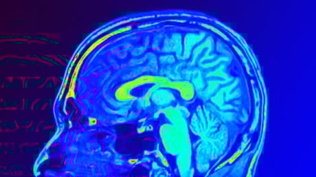 Az agyi MRI új korszakot nyithat a depresszió gyógyításában