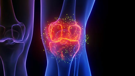 Az artritisz végóráit jelentheti az új porcregeneráló eljárás