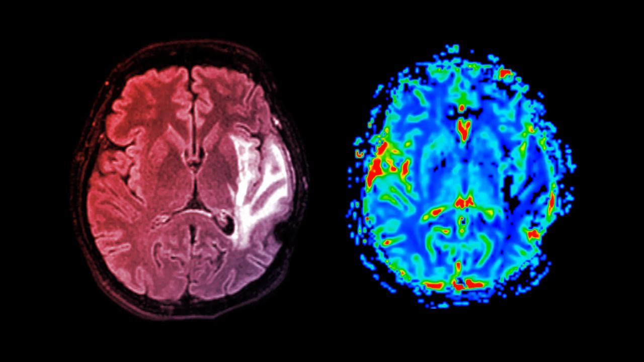 Az elhízás és a magas vérnyomás valóban demenciához vezethet