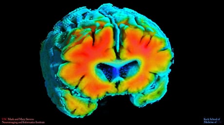 A rejtett szikra az Alzheimer mögött: láthatatlan vérellátási zavar