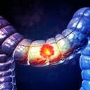 A vastagbélrák rejtélye: miként verik át az immunrendszert?