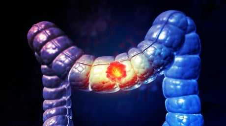 A vastagbélrák rejtélye: miként verik át az immunrendszert?