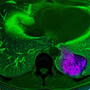 Az agy megtéveszti az immunrendszert: a tüdőrák titkos fegyvere