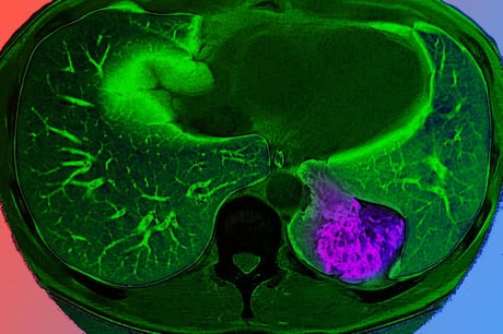 Az agy megtéveszti az immunrendszert: a tüdőrák titkos fegyvere