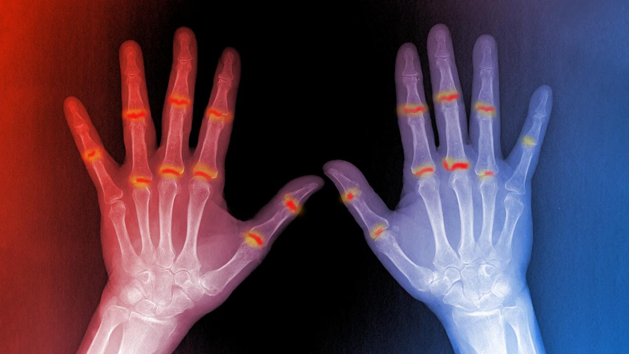 Az alattomos összefüggés: így vezet a pikkelysömör ízületi gyulladáshoz