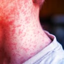 A kanyaró visszatér Amerikában: riadó mindannyiunknak