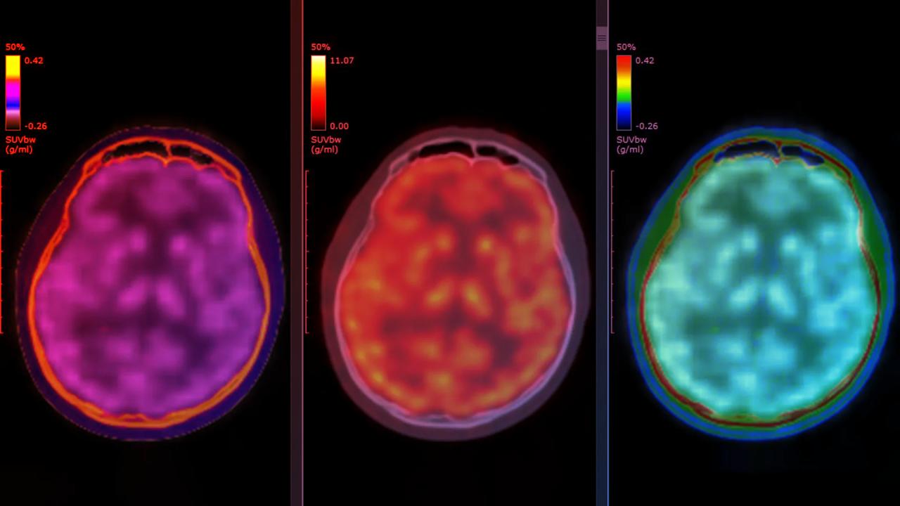 Az agyszkennelés felfedi, mit művel a ketamin a depresszióval