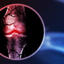 Az áttörés a csontgyógyításban: porcszövet ad lendületet az újranövésnek