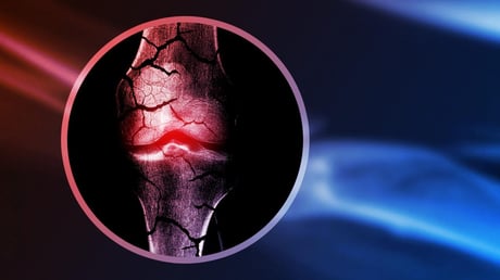 Az áttörés a csontgyógyításban: porcszövet ad lendületet az újranövésnek