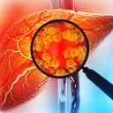 Az áttörést ígérő zsírmájgyógyszer rákveszélyt is hordozhat