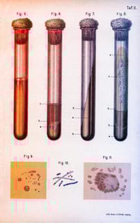 Az elfelejtett gyilkos visszatér: terjed a TBC Amerikában