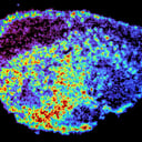 Az igazság: miért vallanak sorra kudarcot a rákgyógyszerek?
