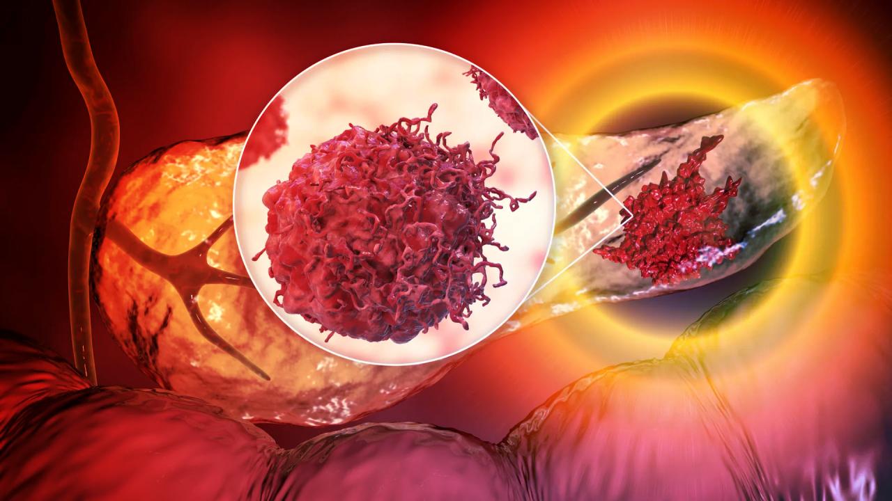 Egy vérteszt áttörést hozhat a hasnyálmirigyrák korai felismerésében